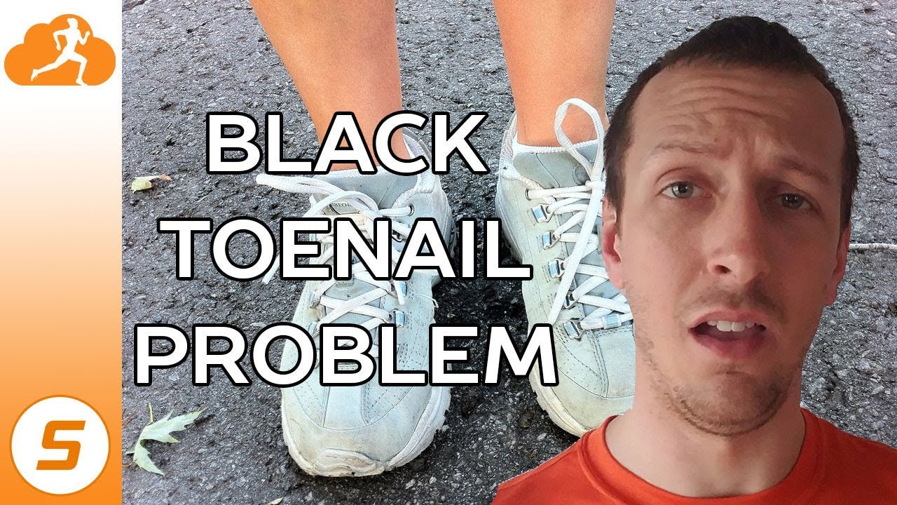 Black Toenails from Running - How to Fix It